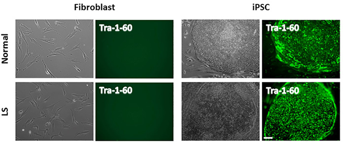 iPSCs from normal and patient fibroblasts were prepared as described in materials and methods.