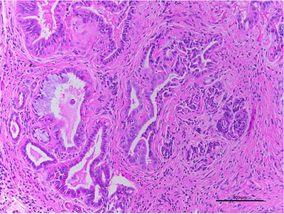 mouse models of pancreatic cancer