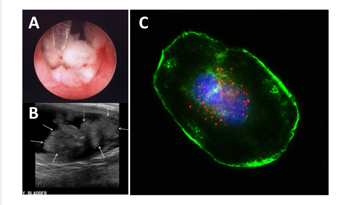 Could Anthrax Help Fight Bladder Cancer?