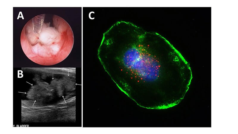 Could Anthrax Help Fight Bladder Cancer?